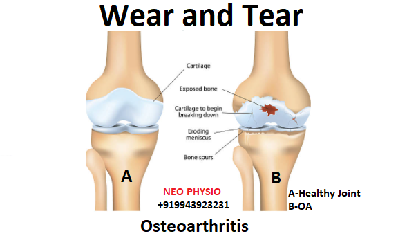 Physiotherapy for Arthritis in Coimbatore